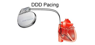 DDD_pacing